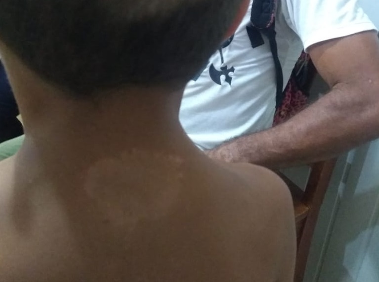 Criança da comunidade Alto Xingu com manchas na pele Criança da comunidade Alto Xingu com manchas na pele